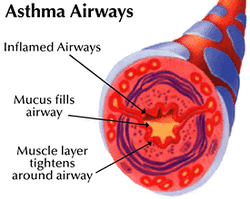 Common corticosteroids for asthma